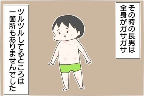 アトピー性皮膚炎で緊急入院（後編）！ 母が学んだことは【産後太りこじらせ母日記 第29話】