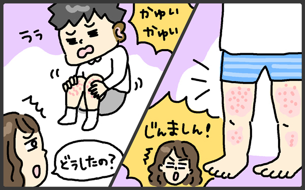 子どもの肌は繊細！ 乾燥や寒さだけじゃないアレルギーが原因の場合も【メンズかーちゃん～うちのやんちゃで愛おしいおさるさんの物語～ 第74回】