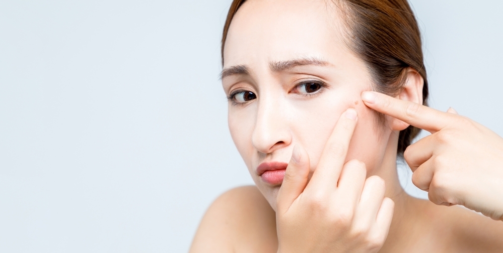 【医師監修】ニキビをつぶすのはNG！　正しいケア方法を知っておこう