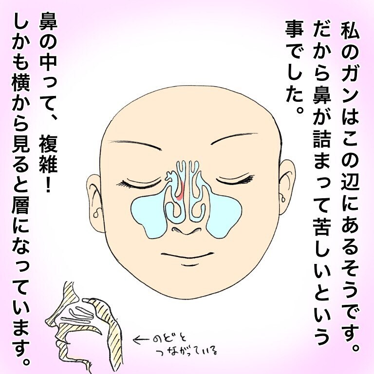 鼻を開く…!?　切開手術の説明が怖すぎる…【鼻腔ガンになった話 Vol.12】