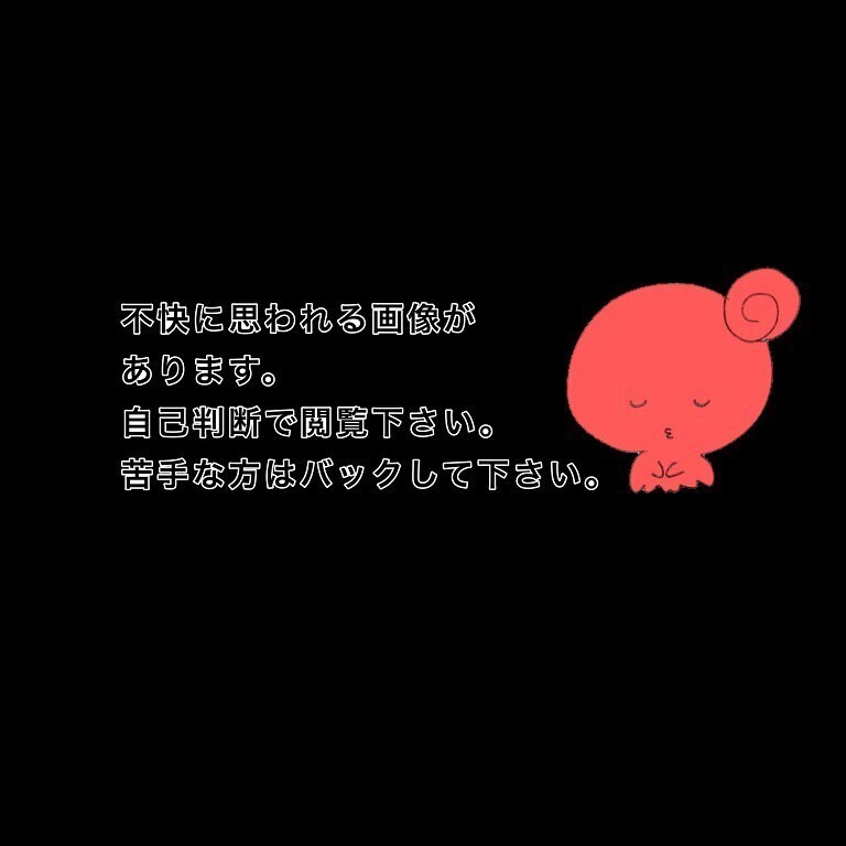 治療後に鼻をかんだら何かが出てきた　これは一体…？【鼻腔ガンになった話 Vol.30】