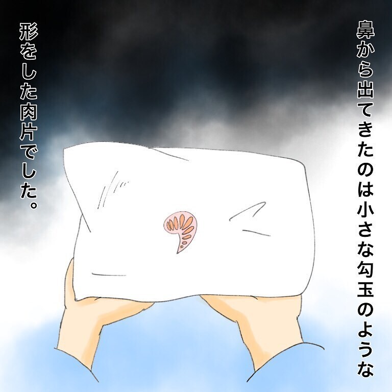 治療後に鼻をかんだら何かが出てきた　これは一体…？【鼻腔ガンになった話 Vol.30】