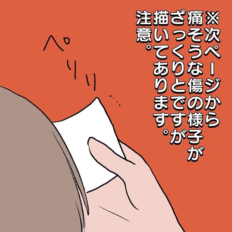 通院後、傷の状態はいかに？　再処置を迷う母の最後の切り札【初めての子どもの大けが Vol.9】