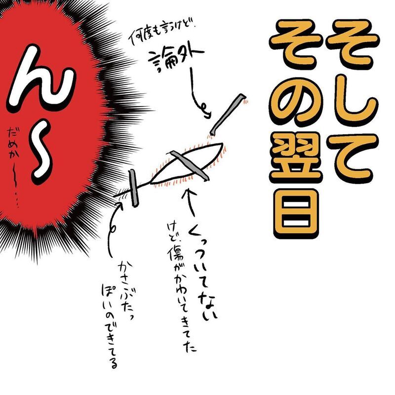 通院後、傷の状態はいかに？　再処置を迷う母の最後の切り札【初めての子どもの大けが Vol.9】