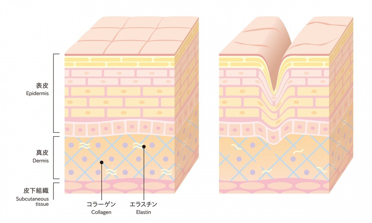 【医師監修】マスク生活で急増中？！ 気になる「毛穴のお悩み」原因と対策（後編）【今の時代だから気になる！ 美容医療にできること Vol.2】