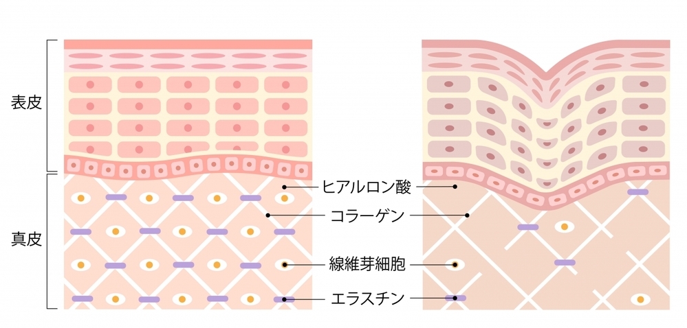 【医師監修】マスク生活で急増中？！ 気になる「毛穴のお悩み」原因と対策（後編）【今の時代だから気になる！ 美容医療にできること Vol.2】