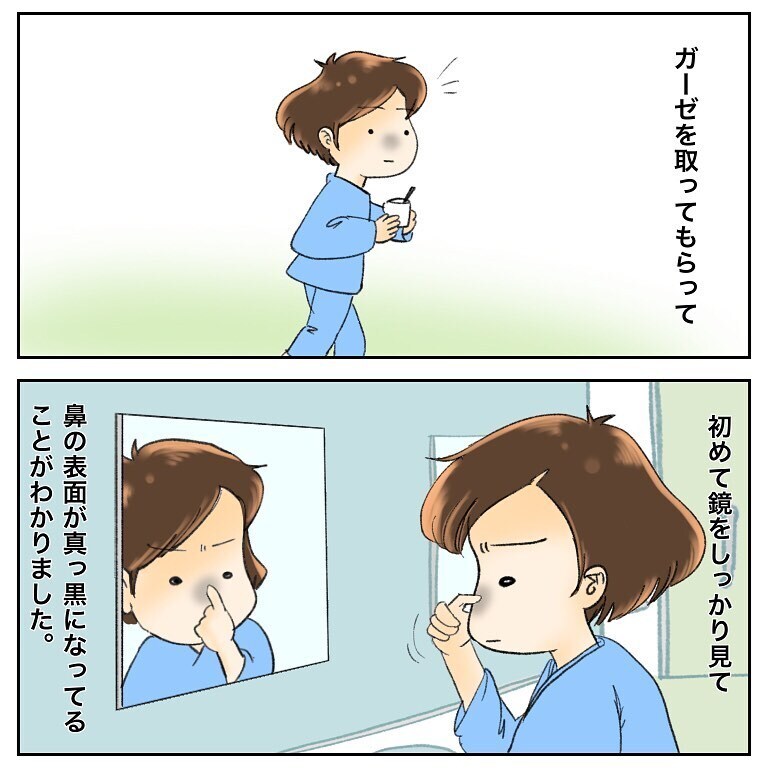 痛い！ 痛すぎる！ 麻酔が切れ、切除した部分が痛んで眠れない！【鼻腔ガンになった話 Vol.56】