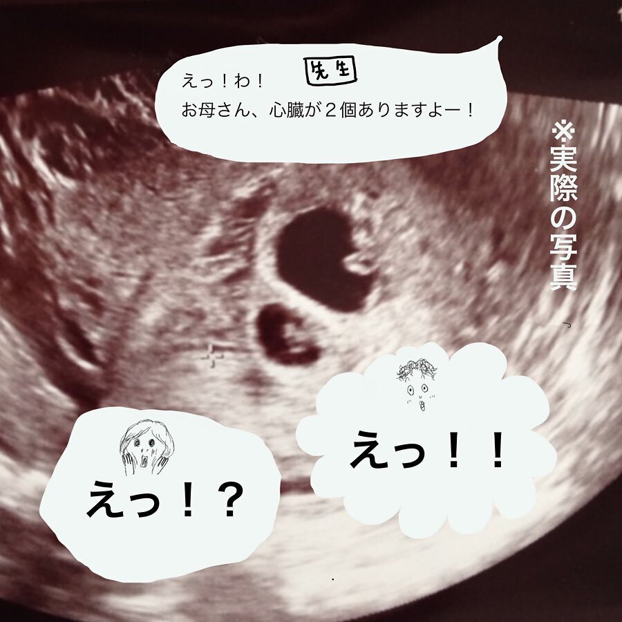 突然の双子妊娠に動揺!? 多胎妊娠のリスクを知り不安に…【双子妊娠出産レポ Vol.1】