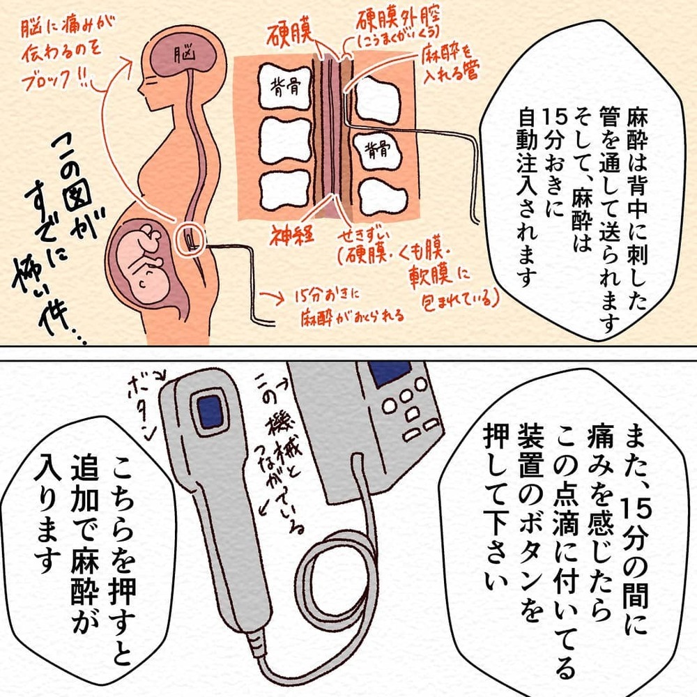 全力でエビのように丸くなれ!?　陣痛から逃れるためにはやるしかない！【無痛分娩で産みました  Vol.3】