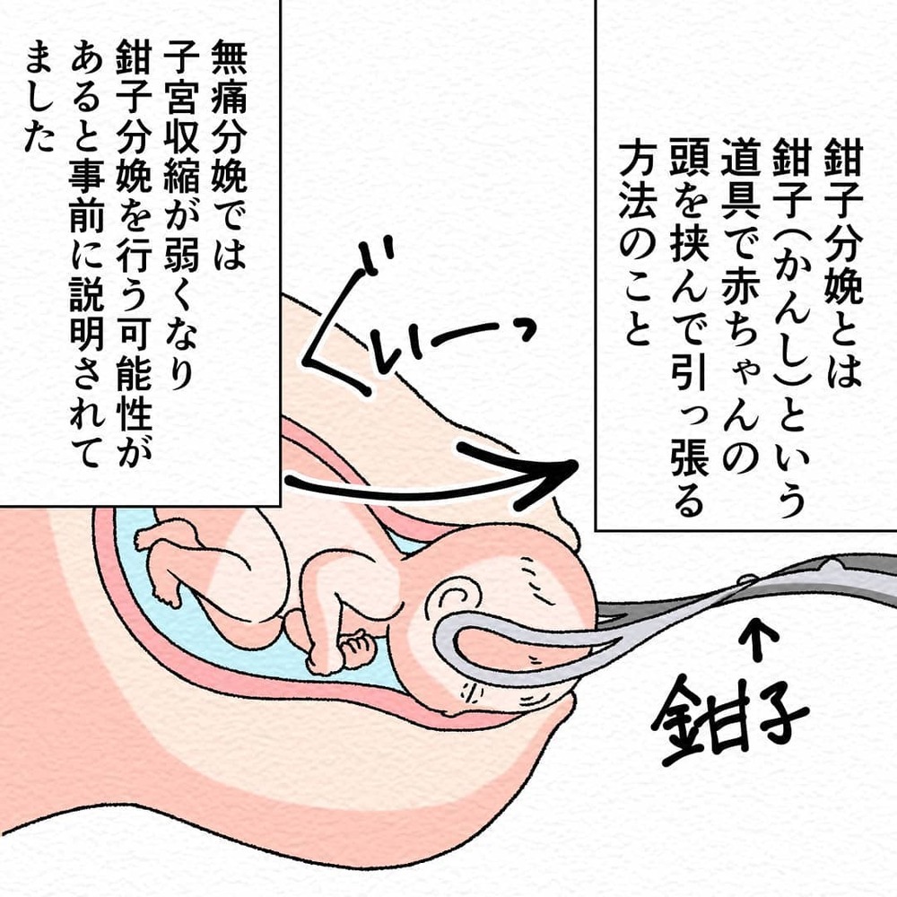 いきみの練習後ついに出産のとき！　痛みはなくても怖い…【無痛分娩で産みました  Vol.5】