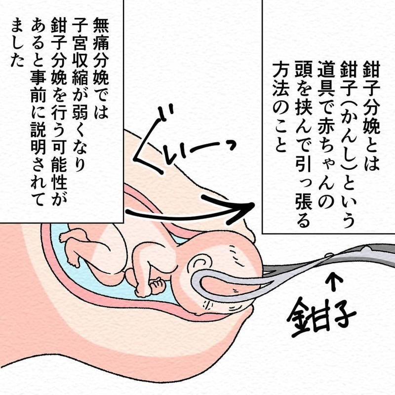 いきみの練習後ついに出産のとき！　痛みはなくても怖い…【無痛分娩で産みました  Vol.5】