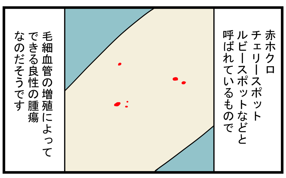 加齢により増える!? 息子が見つけてくれた私の「真っ赤なホクロ」【こどもと見つけた小さな発見日誌 Vol.43】