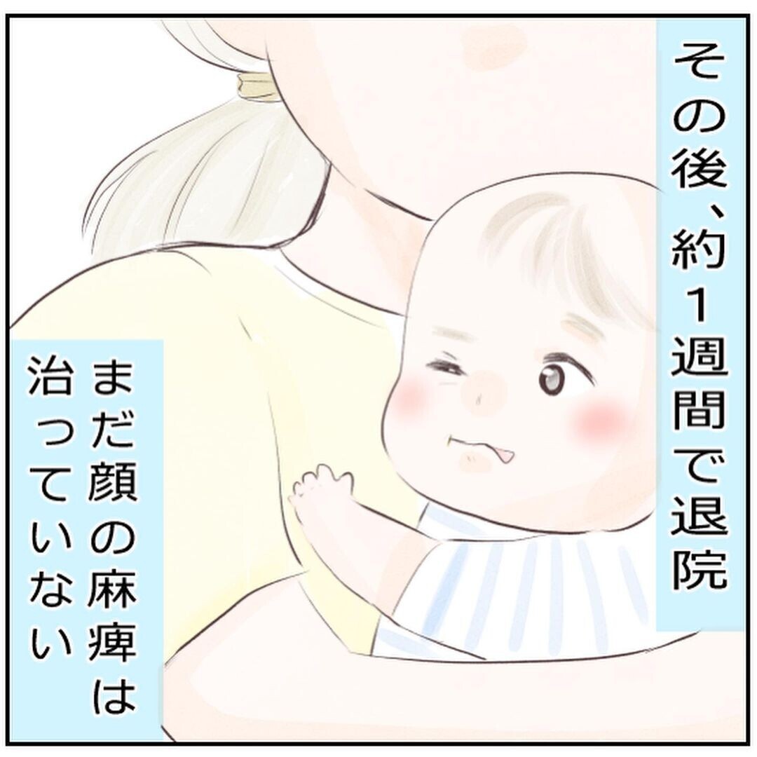 退院後もマッサージ 目薬でケア 1歳半になった息子は今 生後3ヶ月の息子が小児顔面麻痺に Vol 11 ウーマンエキサイト 1 2