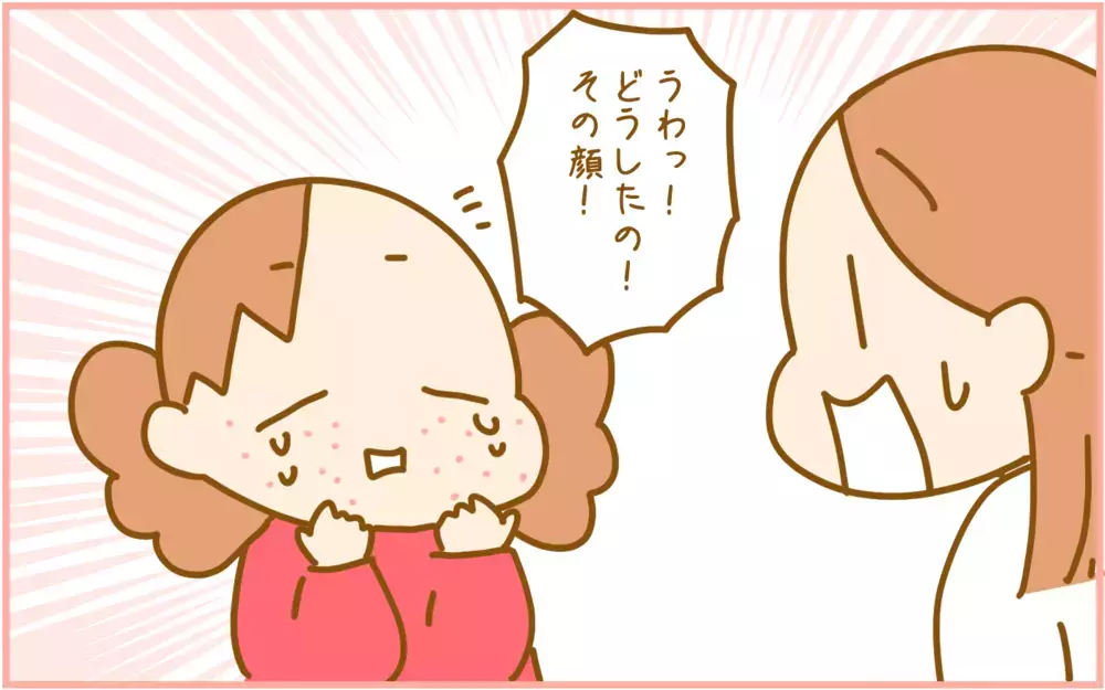 赤ちゃんの頃だけじゃない!?  娘が4歳で「突発性発疹」になった話【ふたごむすめっこ×すえむすめっこ 第92話】