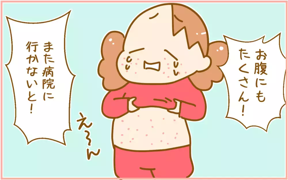 赤ちゃんの頃だけじゃない!?  娘が4歳で「突発性発疹」になった話【ふたごむすめっこ×すえむすめっこ 第92話】
