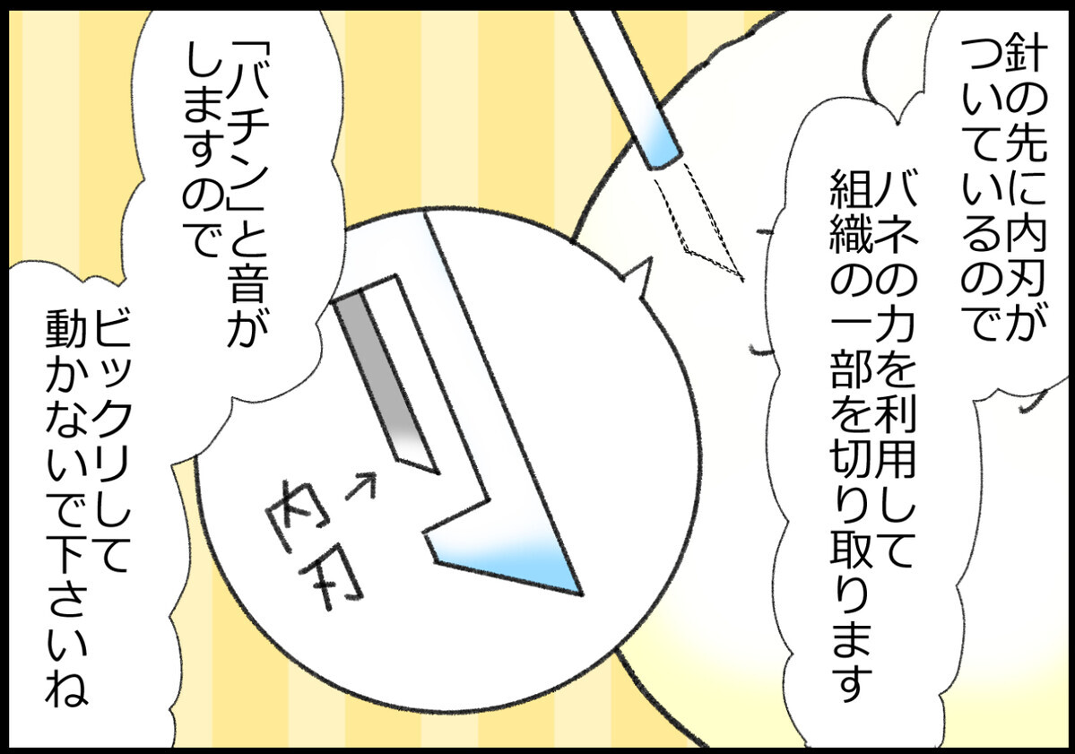 針の先に内刃がついていて、バネの力を利用して組織の一部を切り出します。