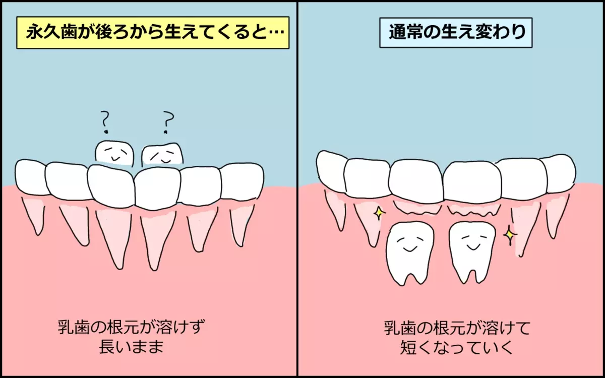 乳歯が長いまま埋もれていたそうです