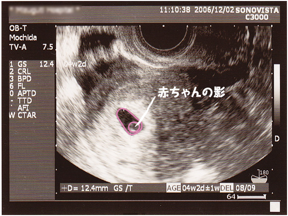 妊娠2ヶ月のエコー 超音波 写真 16年4月4日 ウーマンエキサイト