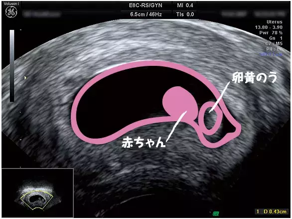 妊娠2ヶ月のエコー（超音波）写真