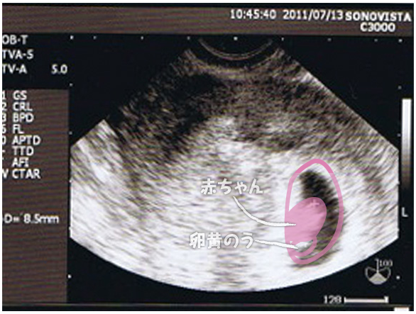 妊娠2ヶ月のエコー 超音波 写真 16年4月4日 ウーマンエキサイト