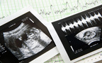 妊娠3ヶ月のエコー（超音波）写真
