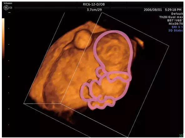 妊娠3ヶ月のエコー（超音波）写真