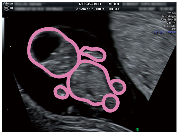 妊娠3ヶ月のエコー 超音波 写真 16年4月4日 ウーマンエキサイト