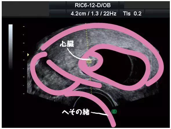 妊娠3ヶ月のエコー（超音波）写真