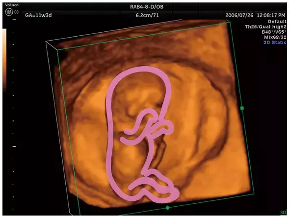 妊娠3ヶ月のエコー（超音波）写真