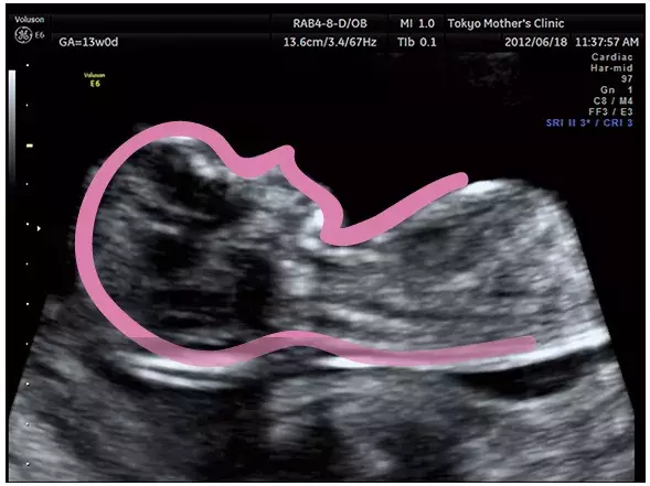 妊娠4ヶ月のエコー（超音波）写真