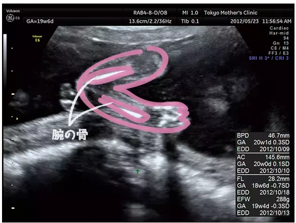 妊娠5ヶ月のエコー（超音波）写真