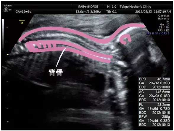 妊娠5ヶ月のエコー（超音波）写真