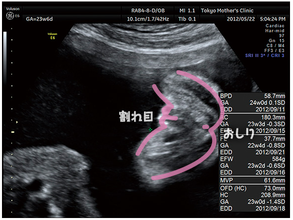 妊娠6ヶ月のエコー 超音波 写真 16年4月4日 ウーマンエキサイト