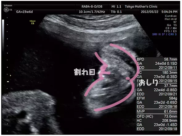 妊娠6ヶ月のエコー（超音波）写真