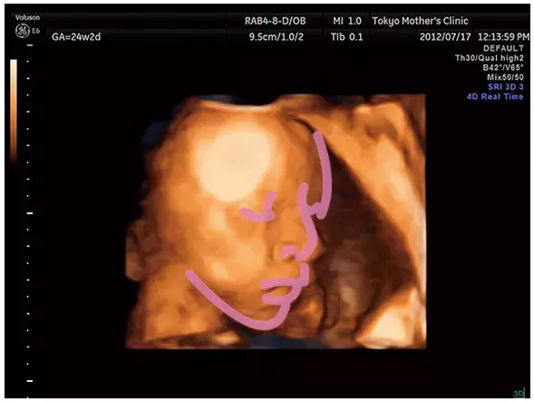 妊娠7ヶ月のエコー（超音波）写真