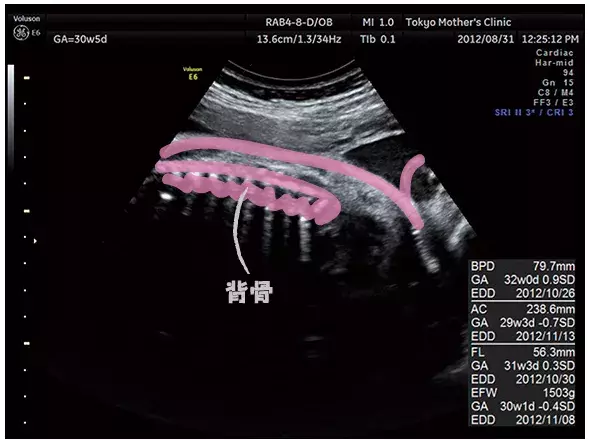 妊娠8ヶ月のエコー（超音波）写真