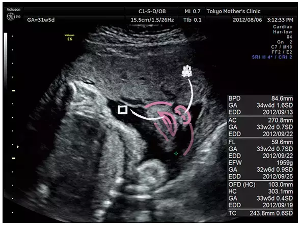 妊娠8ヶ月のエコー（超音波）写真