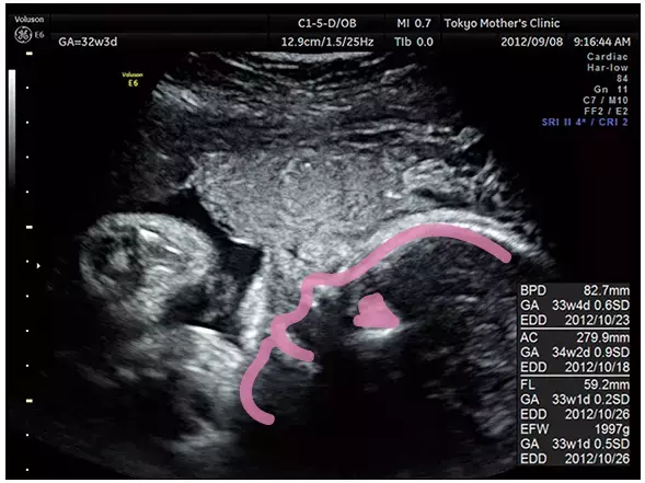妊娠9ヶ月のエコー（超音波）写真