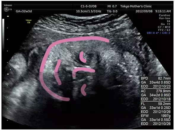 妊娠9ヶ月のエコー（超音波）写真