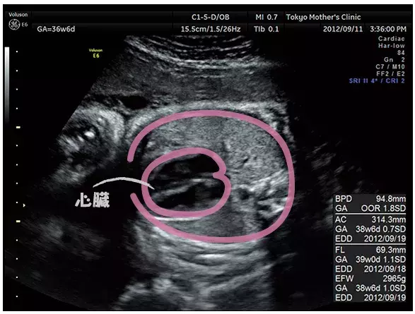 妊娠10ヶ月のエコー（超音波）写真