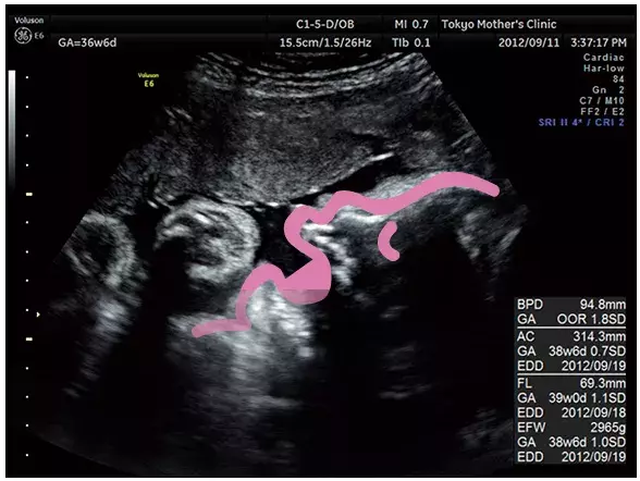 妊娠10ヶ月のエコー（超音波）写真
