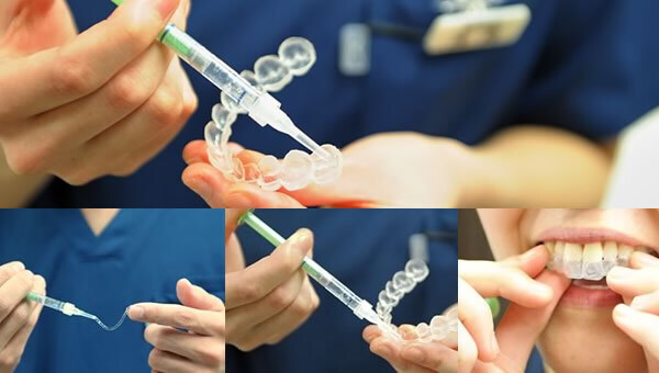 【歯科医監修】ホワイトニングはどこも同じじゃない？ 注意点と自宅ケアの費用や方法