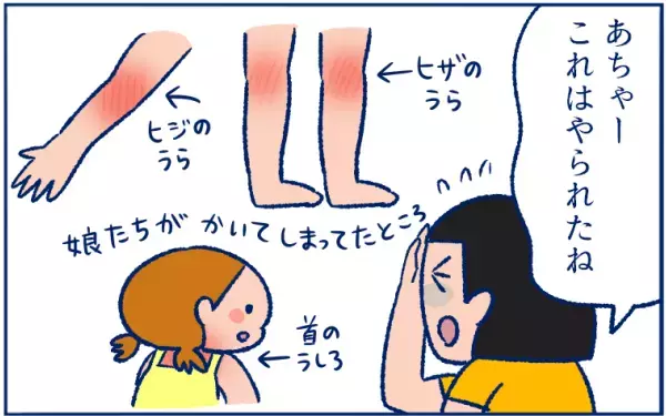 とびひを甘く見ていた…！ 体中にとびまくり、最後は丸坊主の危機に!?【双子育児まめまめ日記 第9話】