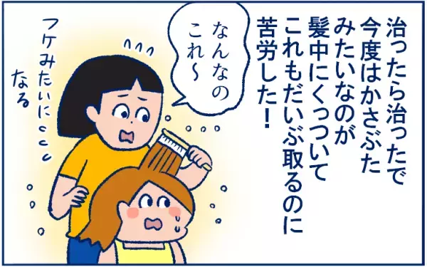 とびひを甘く見ていた…！ 体中にとびまくり、最後は丸坊主の危機に!?【双子育児まめまめ日記 第9話】