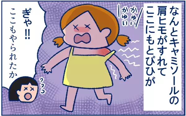とびひを甘く見ていた…！ 体中にとびまくり、最後は丸坊主の危機に!?【双子育児まめまめ日記 第9話】