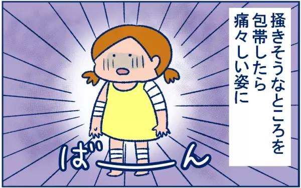 とびひを甘く見ていた…！ 体中にとびまくり、最後は丸坊主の危機に!?【双子育児まめまめ日記 第9話】