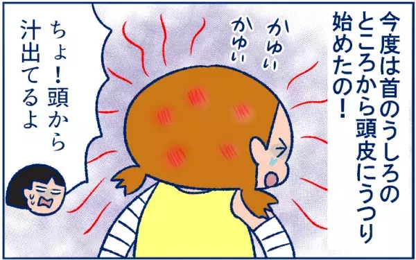 とびひを甘く見ていた…！ 体中にとびまくり、最後は丸坊主の危機に!?【双子育児まめまめ日記 第9話】