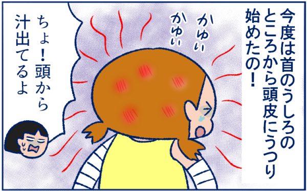 とびひを甘く見ていた 体中にとびまくり 最後は丸坊主の危機に 双子育児まめまめ日記 第9話 ウーマンエキサイト 2 3