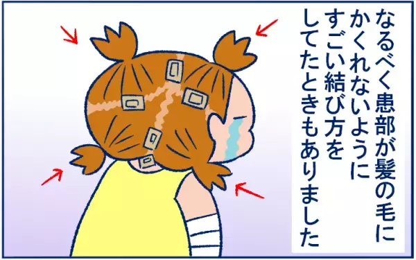 とびひを甘く見ていた…！ 体中にとびまくり、最後は丸坊主の危機に!?【双子育児まめまめ日記 第9話】