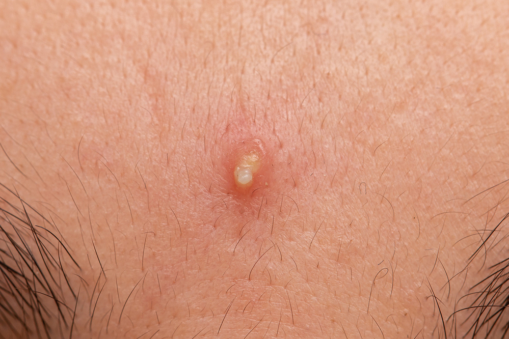 【医師監修】黄ニキビはつぶす？　放置する？　正しい対処方法を知ろう